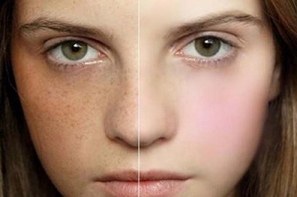 Khoai Tây cũng là một trong những bí quyết trị đốm đen trên da hiệu quả nhất.