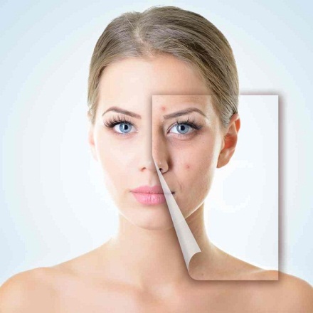 Tuổi 30 – thời điểm xuất hiện những nếp nhăn, mụn và cả sự lão hóa da.
