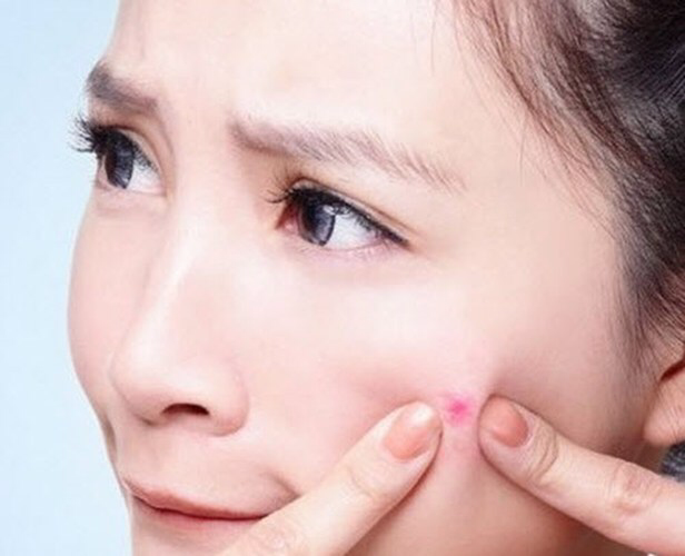 Nặn mụn không tốt cho làm đẹp da
