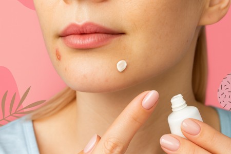 Top 10 cách trị mụn bằng kem đánh răng hiệu quả