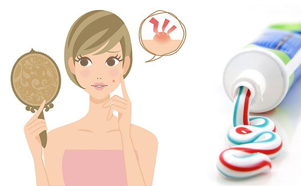 Top 10 cách trị mụn bằng kem đánh răng hiệu quả