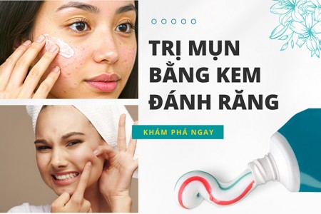 Top 10 cách trị mụn bằng kem đánh răng hiệu quả