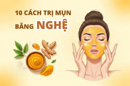 Top 10 cách trị mụn bằng nghệ hiệu quả nhất