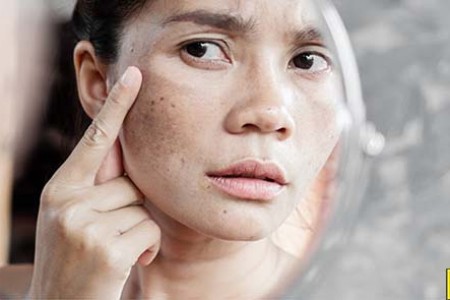 Tăng sắc tố melanin làm cho da bị nám, sậm màu