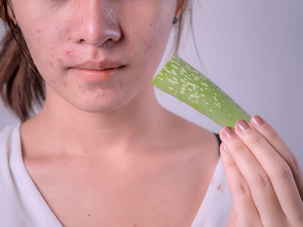 Top 10 cách trị mụn bằng nha đam hiệu quả