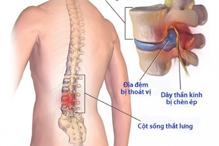 Phát hiện thoát vị đĩa đệm từ chứng đau lưng