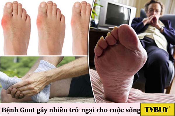 vị trí thường thấy của bệnh gout
