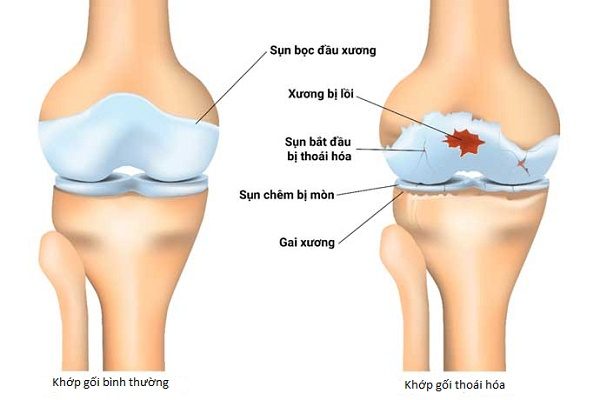 khớp gối thoái hóa