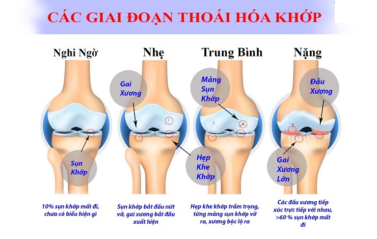 các giai đoạn thoái hóa khớp gối