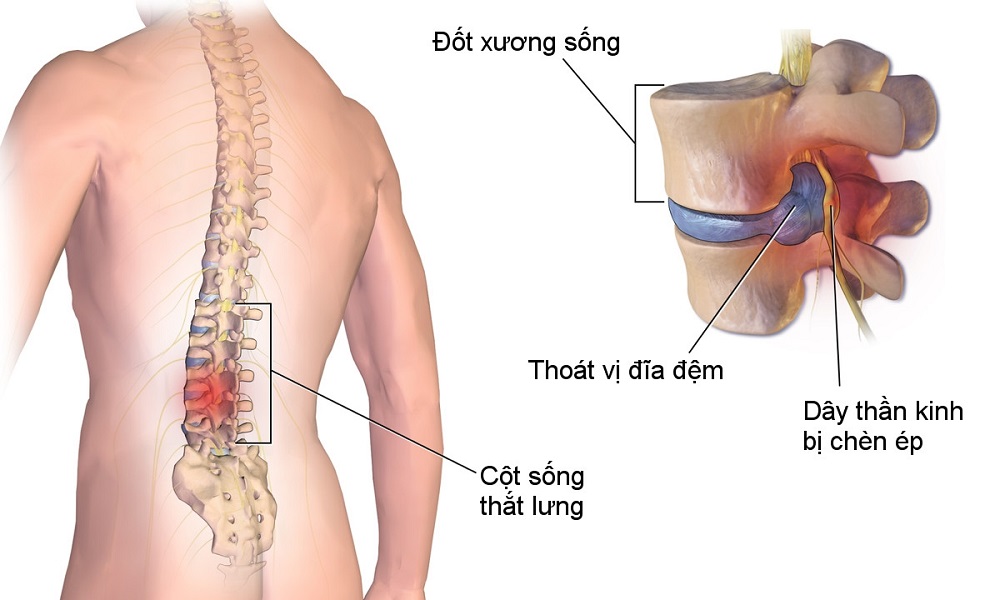 Phát hiện thoát vị đĩa đệm từ chứng đau lưng 02