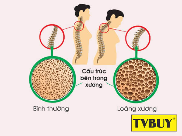Loãng xương là nguyên nhân hàng đầu khiến cơ thể con người dần bị lùn đi Loãng xương là nguyên nhân hàng đầu khiến cơ thể con người dần bị lùn đi