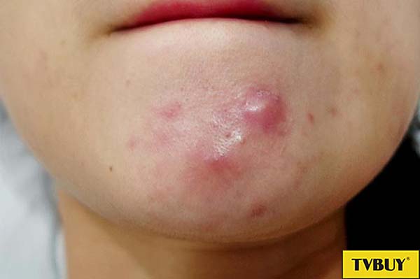 mụn bọc là gì?