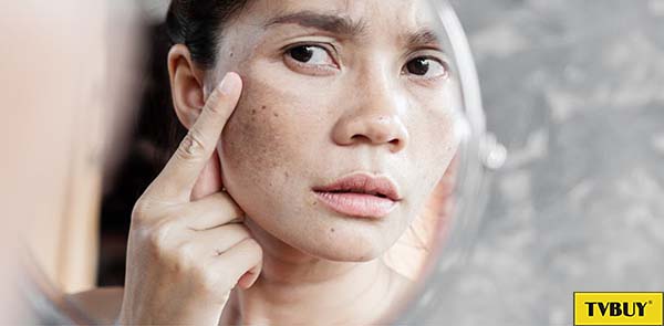 trị nám sạm da