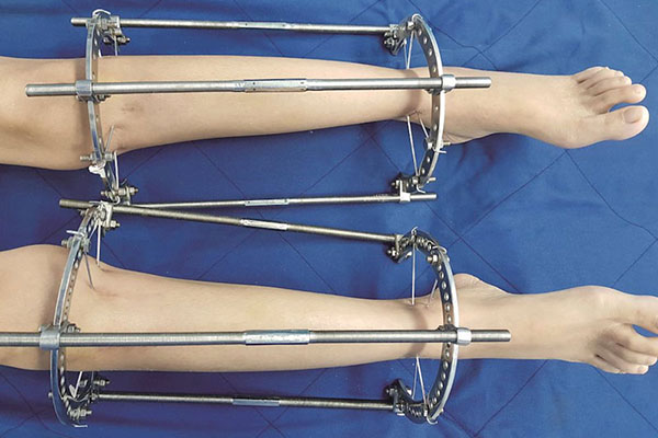 Phẫu thuật kéo dài chân tiềm ẩn nhiều rủi ro