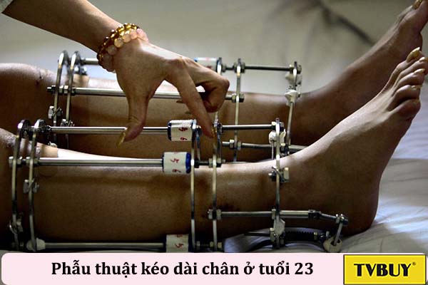 phẫu thuật kéo dài chân