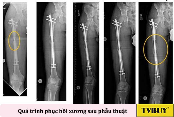 quá trình phục hồi xương sau phẫu thuật