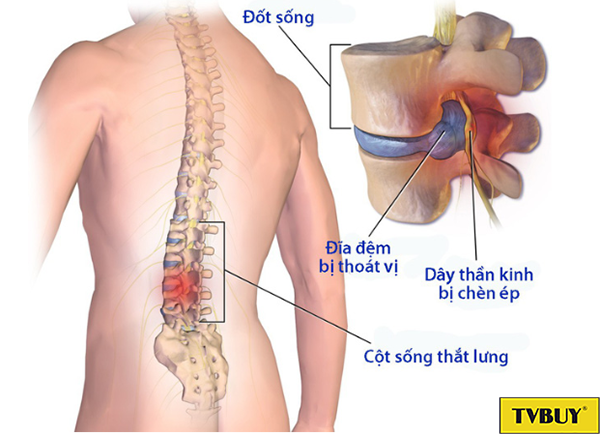 tác hại thoát vị đĩa đệm
