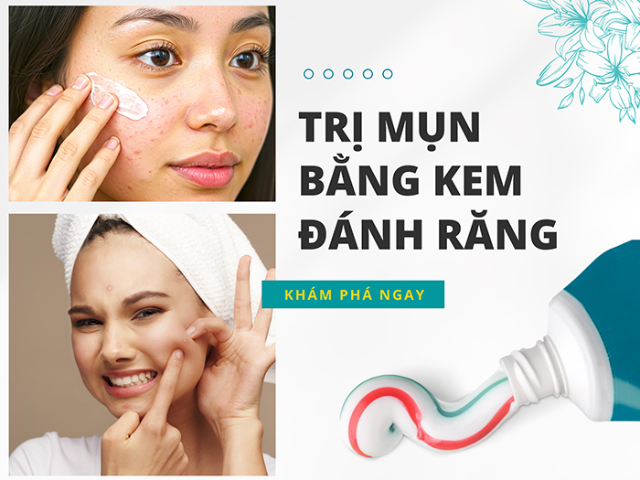 Trị mụn bằng kem đánh răng mang lại hiệu quả nhất định