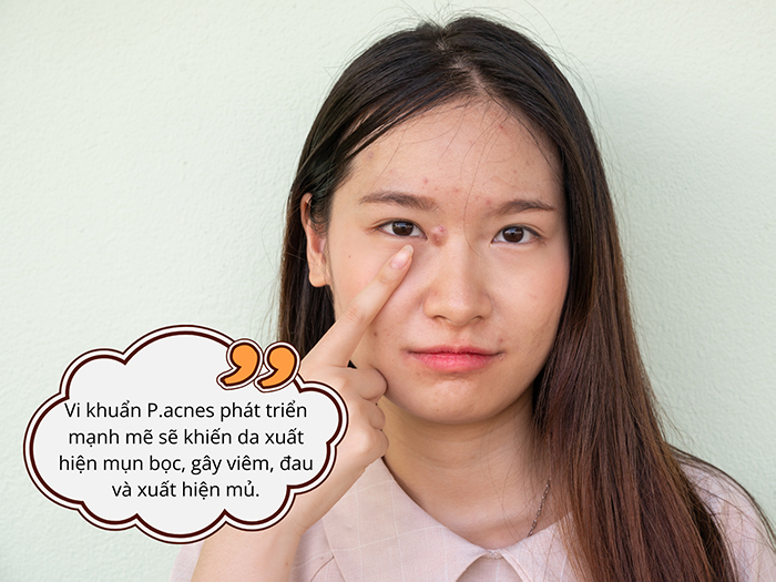 Vi khuẩn P.acnes khiến da bị mụn bọc nghiêm trọng