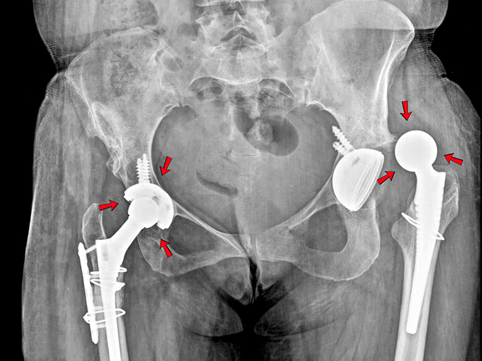 ​​​​​​​Lệch khớp háng là tình trạng biến chứng nguy hiểm dễ dẫn tới dị tật chân, khiến việc đi lại bất thường