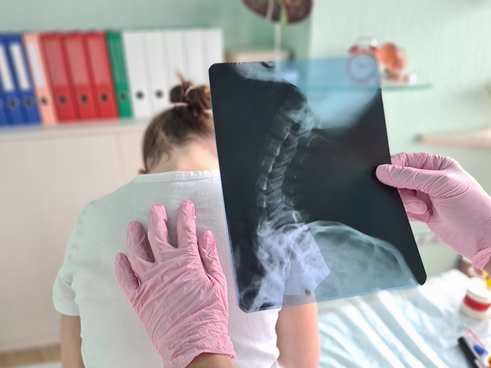 ​​​​​​​Không chỉ gây lệch khớp háng, chân vòng kiềng còn khiến phần cột sống bị biến dạng&nbsp;