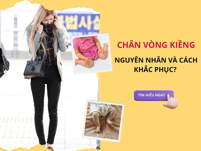 Chân vòng kiềng - nguyên nhân và cách khắc phục?&nbsp;