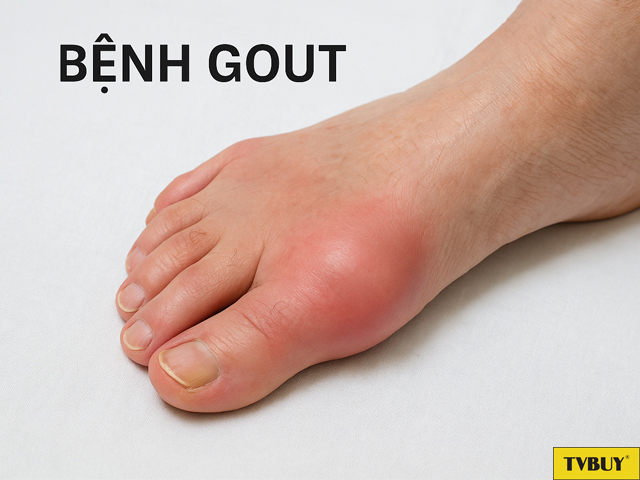 vị trí thường thấy của bệnh gout