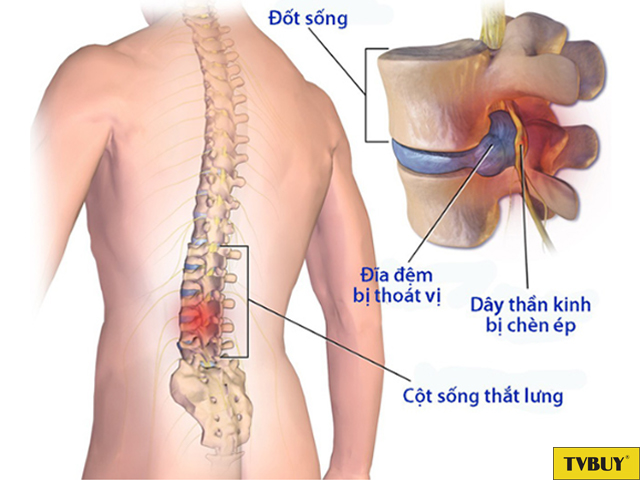 tác hại thoát vị đĩa đệm