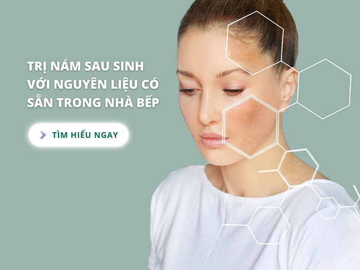 Trị nám sau sinh với nguyên liệu tự nhiên với hiệu quả cao