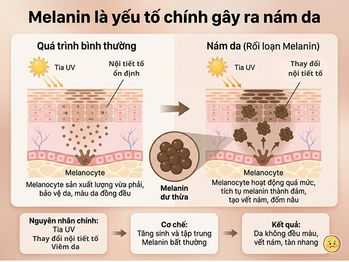 Các nguyên nhân chính gây nám da
