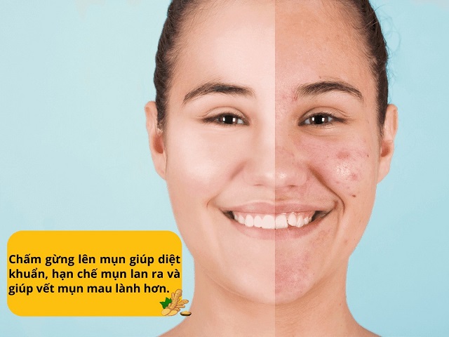 Gừng tươi chấm mụn hoặc đắp mặt giúp trị mụn