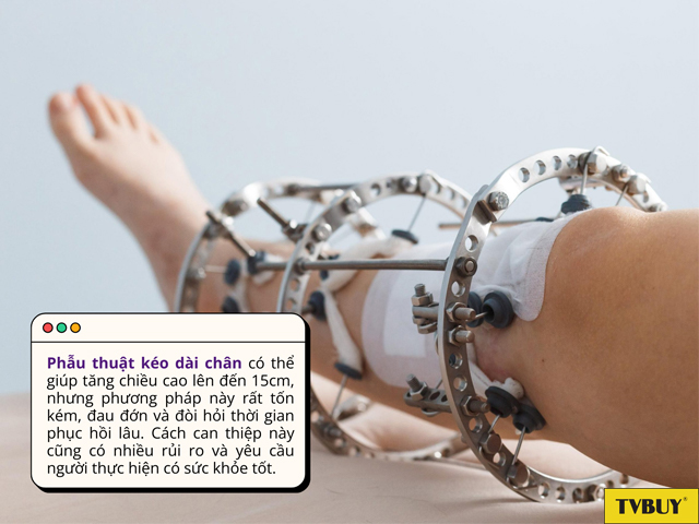 Phẫu thuật kéo dài cân là cách can thiệp giúp tăng chiều cao trong thời gian ngắn
