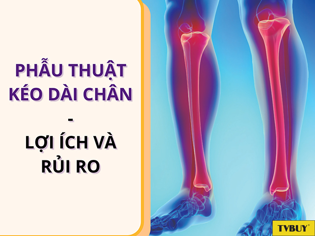 Phẫu thuật kéo dài chân đã có từ lâu với nhiều lợi ích và rủi ro khác nhau